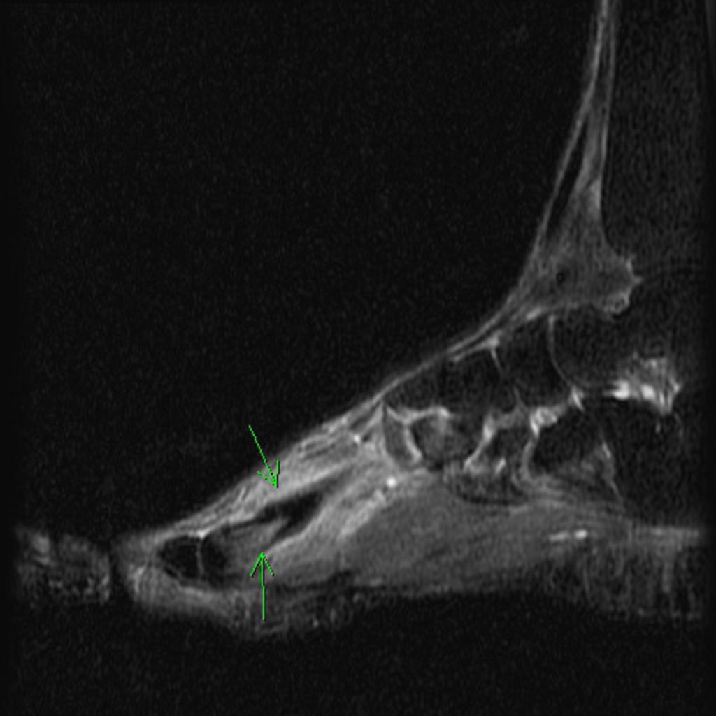 Stress fracture with periosteal reaction.