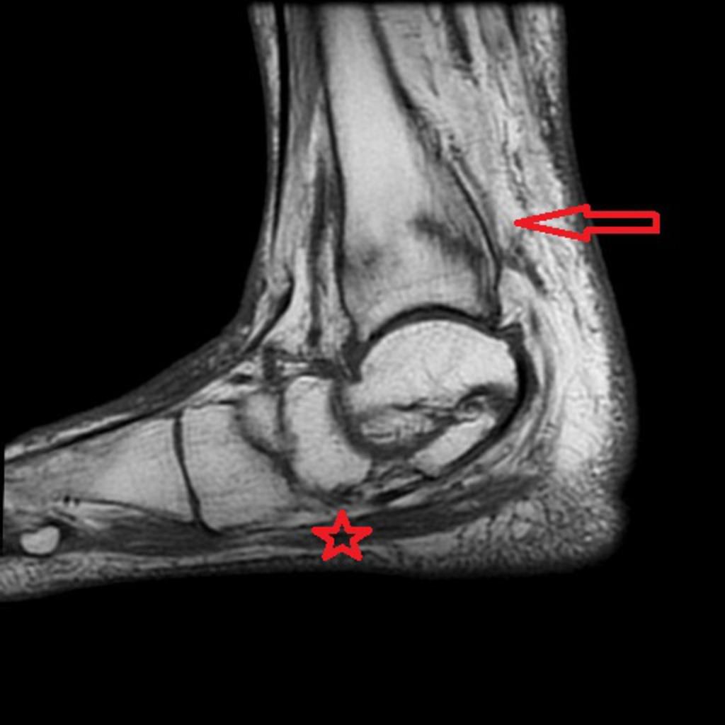 31: T1-Insufficiency fractures in the distal tibia. References: TTSH.