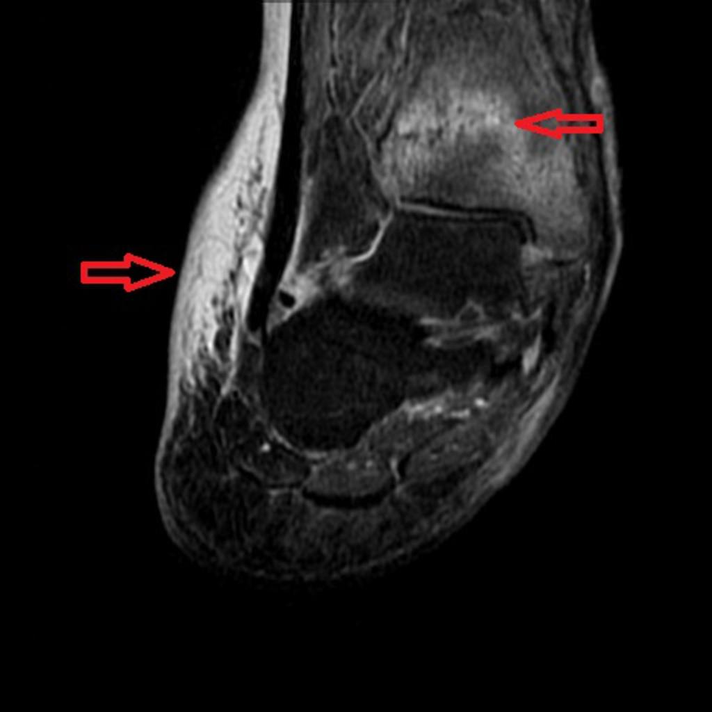 Hyperintensity due to marrow oedema and insufficiency fracture of distal tibia.