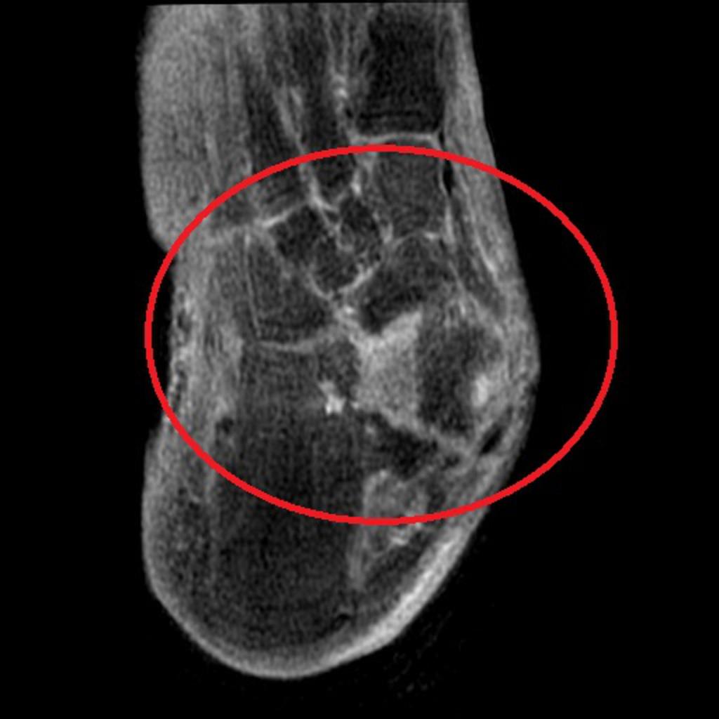Fig. 34: Periarticular erosions with synovitis due to