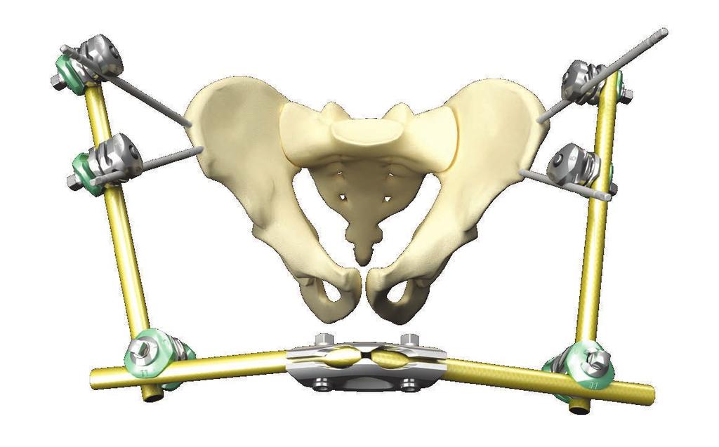 Pelvic frames Pelvic osteotaxis frame Independent iliac crest pin placement, with rod