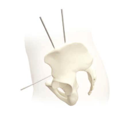 Sterile field kit B Femoral safe zone Between anterolateral and lateral sites.