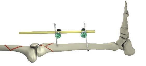and a third bar to achieve a z-frame here shown as a knee-bridging frame (Fig. 7).