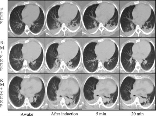 From: Prevention of Atelectasis in Morbidly Obese Patients during General Anesthesia and Paralysis:A Computerized Tomography Study Anesthesiology. 2009;111(5):979-987. doi:10.1097/aln.