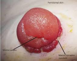 Stomal oedema Ileal conduit stoma oedema will begin to subside within 7 days