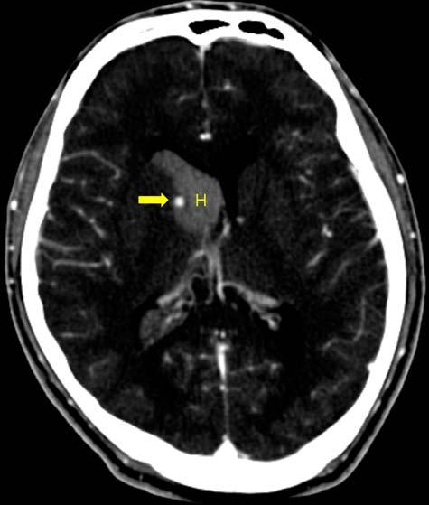 TACKEUN KIM ET AL CASE REPORT Fig. 1. Initial enhanced computed tomography images. Pure intraventricular hemorrhage is observed in the right lateral ventricle.