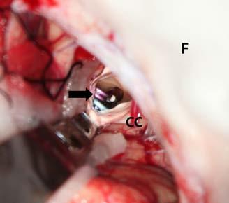 (Arrow: clips, F: falx cerebri, CC: corpus callosum). (C) The head of right caudate nucleus is dissected and pseudoaneurysm is totally resected (Arrow: caudate nucleus, F: falx cerebri).