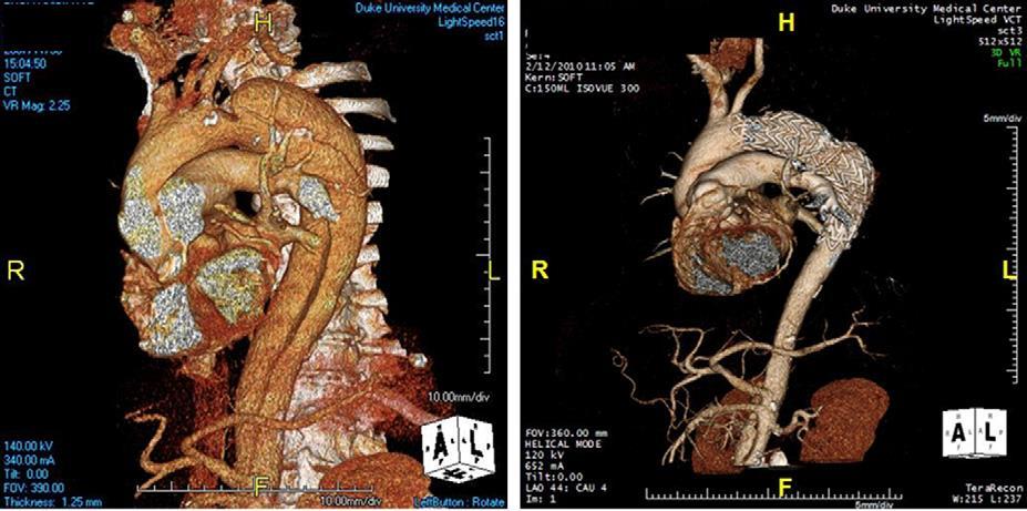 Aortic Remodeling in Chronic Type B Dissection Chronic type B