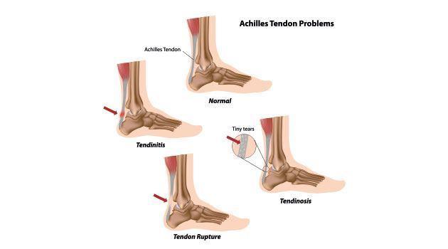 Potential issues with the tendo achilles Midportion Achilles - tendinopathy wide-spread disorder. Prevalence of 2.