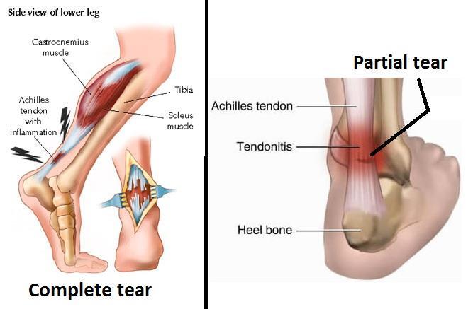 Partial and complete tears of the tendo achilles Can occur suddenly due to increased stress on the tendon May be