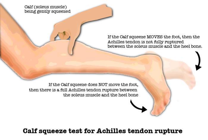 Classic test for complete rupture of the tendon Note in a partial tear the foot may still plantarflex when the calf is squeezed If complete tear go to ED If left for more than 3 weeks cannot be