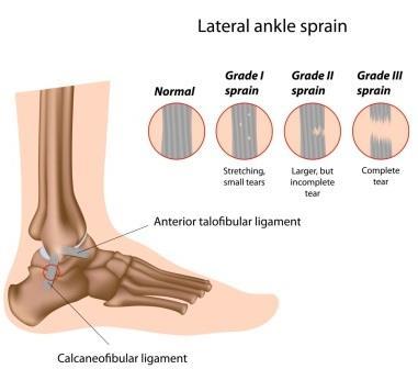 Lateral ligament injuries The anterior band of the lateral ligament is most frequently damaged in an inversion sprain Typical mechanism is foot down a rabbit hole, foot on the edge of a kerb