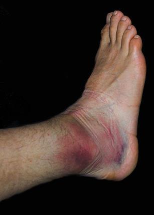 Severe ankle sprain Extensive bruising affecting the lateral and medial aspects of the foot Bruising over the anterior ankle may suggest damage to the ankle joint Significant swelling Inability to
