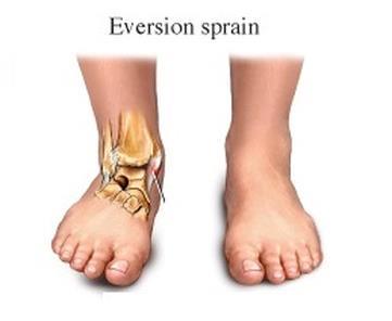 Sprain of the medial ligament This is a less common injury due to the strength of the medial ligament However this can lead to a fracture of the