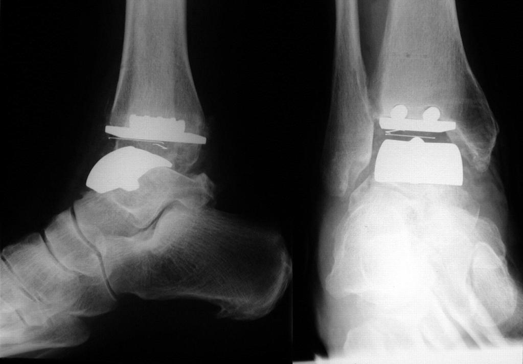 Ankle joint replacement OA can follow severe ankle sprains or previous fractures If conservative management insufficient surgery may be considered Ankle arthrodesis still considered for younger