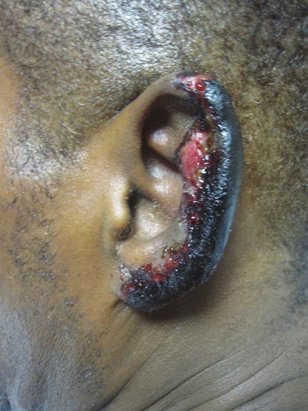 t co Figure 1. A violaceous patch with necrotic bleeding edges and overlying black eschars on the left ear.