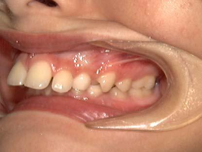Overjet or protruding upper teeth: Upper front teeth that protrude beyond normal contact with the lower front teeth often indicate a poor bite of