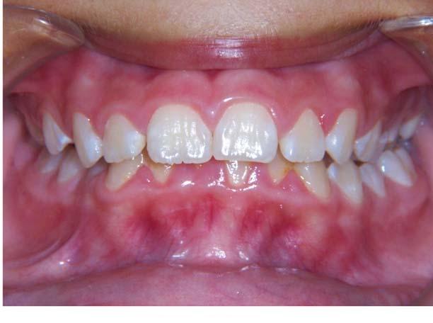Deep overbite: A deep overbite or deep bite occurs when the lower front teeth bite too close or into the gum behind the upper teeth.
