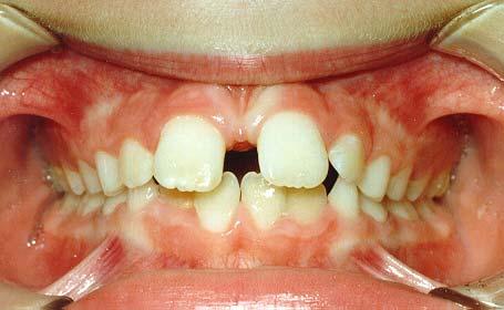 Spacing: If teeth are missing or small for the mouth, space between the teeth can occur.