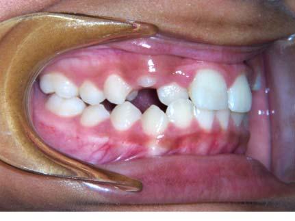 Crossbite: The most common type of a crossbite is when the upper teeth bite inside the lower teeth (toward the tongue).