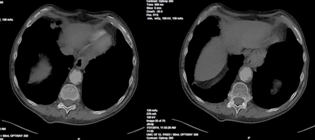 Figure 3. Follow up chest CT showed concentric mural thickening of the mid and distal esophagus which was out of proportion to that seen in a regular achalasia.