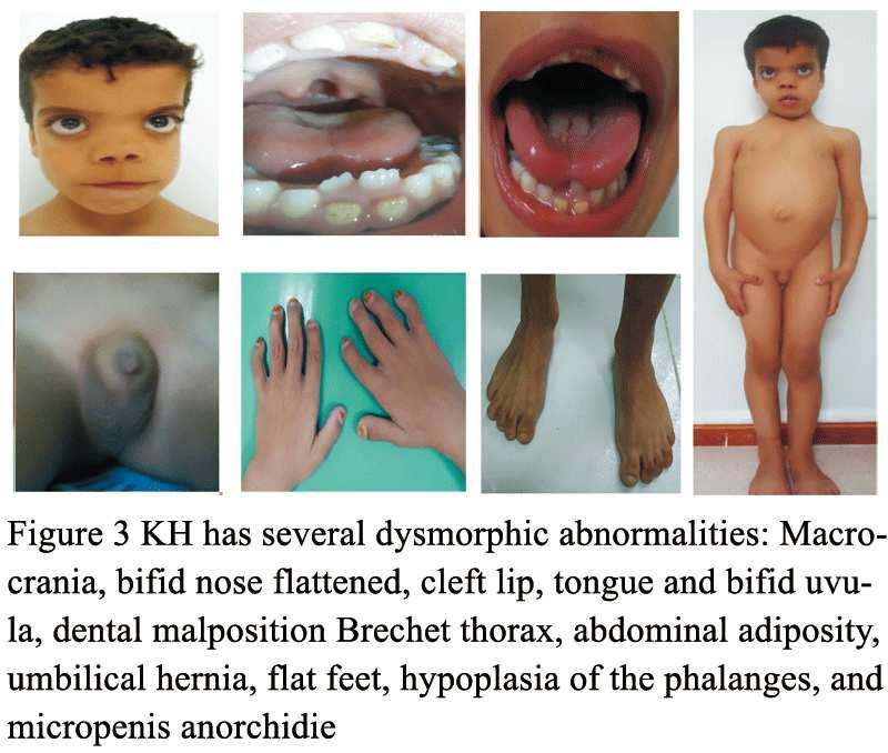 Severe dysmorphic signs Recognition after birth or in childhood Sometimes recognition is in adolescence or in young adulthood ( delay of puberty,