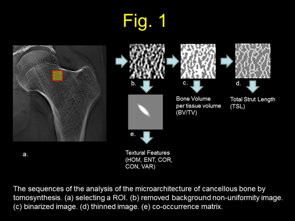 Fig. 1: The sequences of the analysis of the microarchitecture of cancellous bone by tomosynthesis. (a) selecting a ROI.