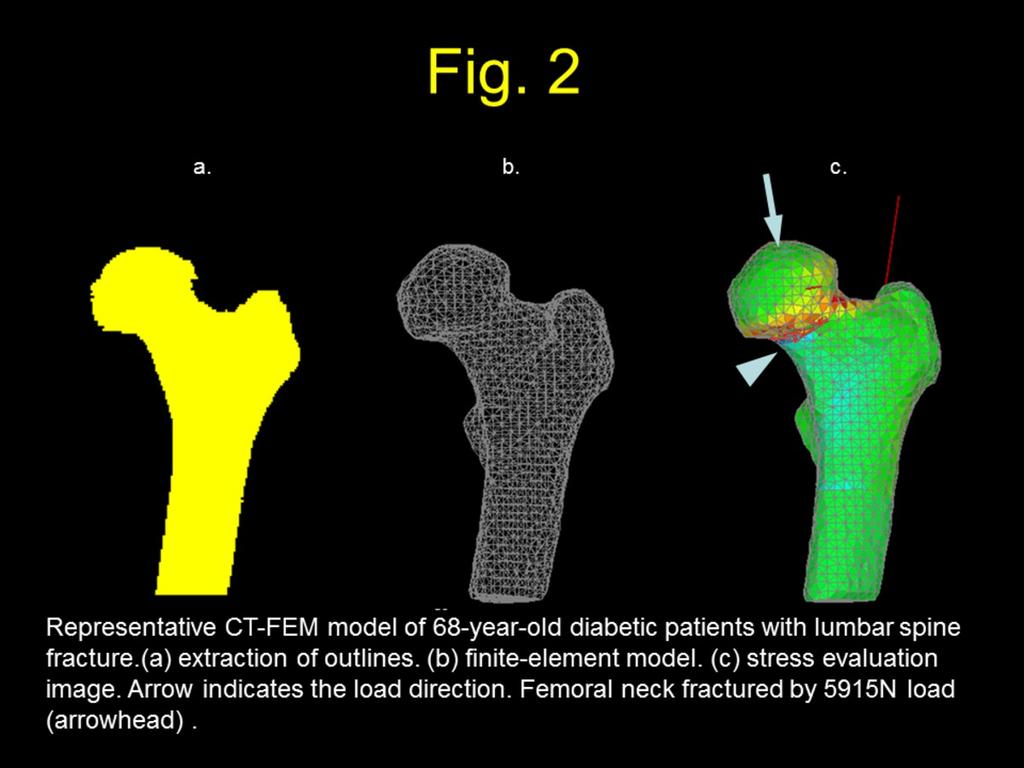 Fig. 2: Representative CT-FEM model of 68-year-old diabetic patients with lumbar spine fracture.(a) extraction of outlines.