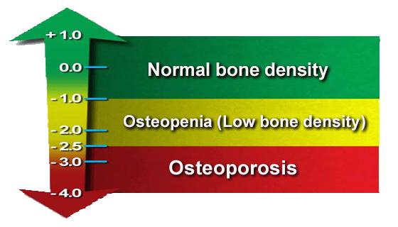 Interpretation of Bone Mineral Density Measurements A clinical diagnosis of osteoporosis may be made when the T-score is 2.