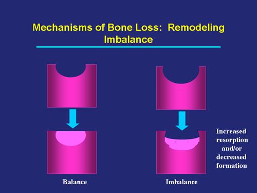 The Mechanisms Underlying the Bone Loss Due to Age and Menopause Mechanisms of Bone Loss Pathogenesis of Osteoporosis Normal