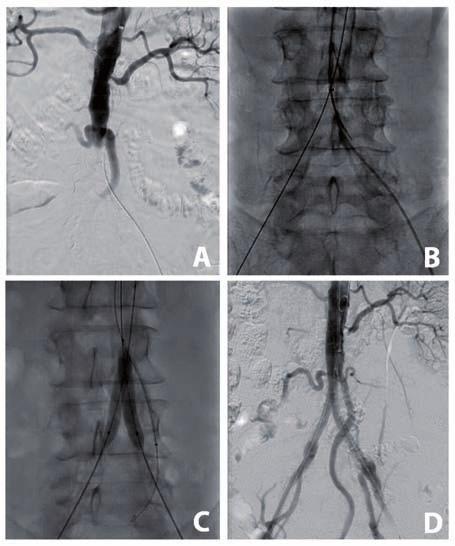 Chapter 6 Figure 1. Chimney CERAB procedure (IMA). Peri-operative fluoroscopy and angiography images showing (A) primary angiography; the distal aorta is occluded.
