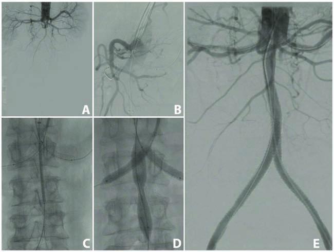 Chimney CERAB Figure 2. Chimney CERAB procedure (bilateral renal arteries).