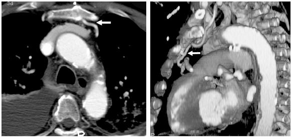 CORONARY ARTERY REOPERATIONS Axial CT image : Preoperative assessment