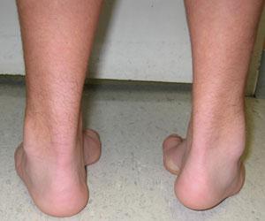 plantarflexion deformity May be observed in CMT CP