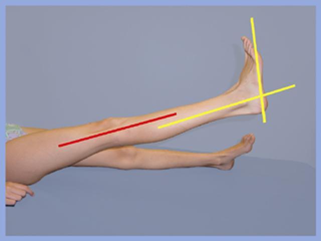 Equinus of Ankle Measure Length of soleus : with knee