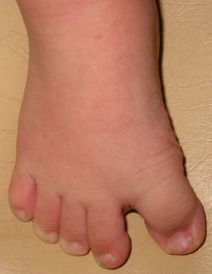 Down syndrome flat pronated feet decreased ankle ROM wide