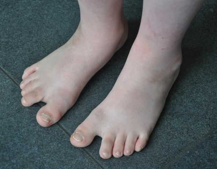during swing common foot conditions hallux abduction,