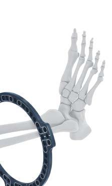 Position the distal ring on the affected limb based on the clinical plan.