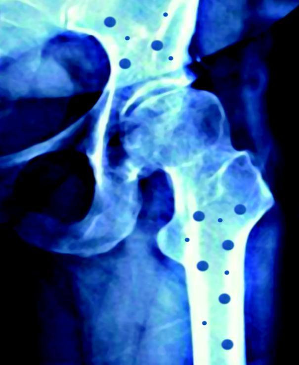 Osteoporosis A disease affecting your bones Osteoporosis is known as the condition which affects bone health, and is presented as loss of bone mass, or inability of the skeletal tissue to reform.