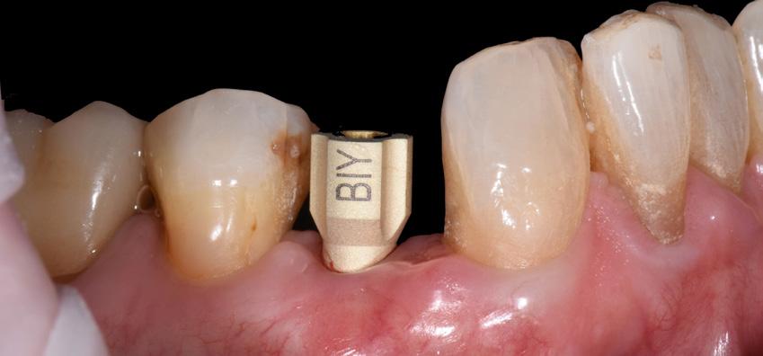 An emergence profile scan which was taken immediately after the healing abutment was removed to record