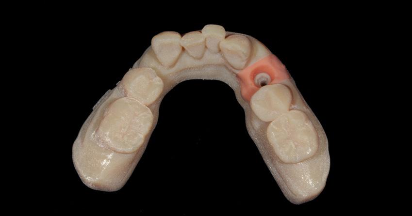 Stage 4 Laboratory fabrication of the final prosthesis A direct access screw-retained crown (Lithium Disilicate crown to a zirconia abutment