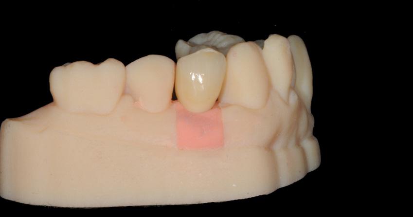 The completed prosthesis was then sent back for the restoration to be inserted. Printed master model. (Fig. 15) Fig.