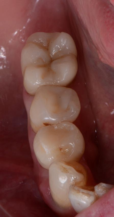Stage 5 Finalization and insert of the screw-retained prosthesis The screw-retained crown was inserted and