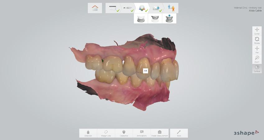 Full arch intraoral surface scans (digital impressions) of the maxillary and mandibular arches as well as the patient s occlusion (bite) were then taken with the use of the 3Shape TRIOS