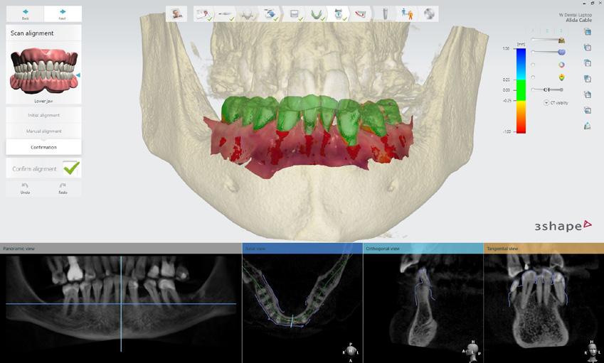 Stage 2 Digital Implant Planning and Surgical Guide Fabrication The patient s TRIOS scans and the DICOM CBCT data were then assimilated and superimposed in 3Shape Implant