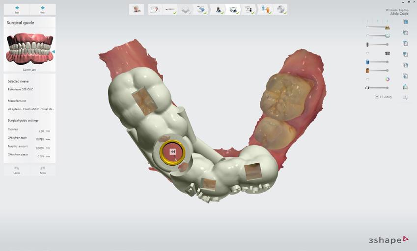 Once the position of the implant was established, a surgical guide with the planned 3-D implant positioning was then