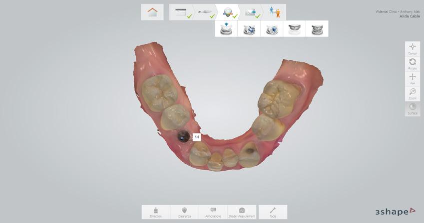 An emergence profile scan which was taken immediately after the healing abutment was removed to record gingival contours around the implant before any collapse of the tissues. 3. The scan body scan.