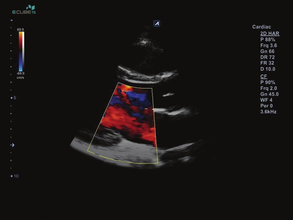 PW in Tissue Doppler imaging displaying a sharp and clear spectrum helps users to