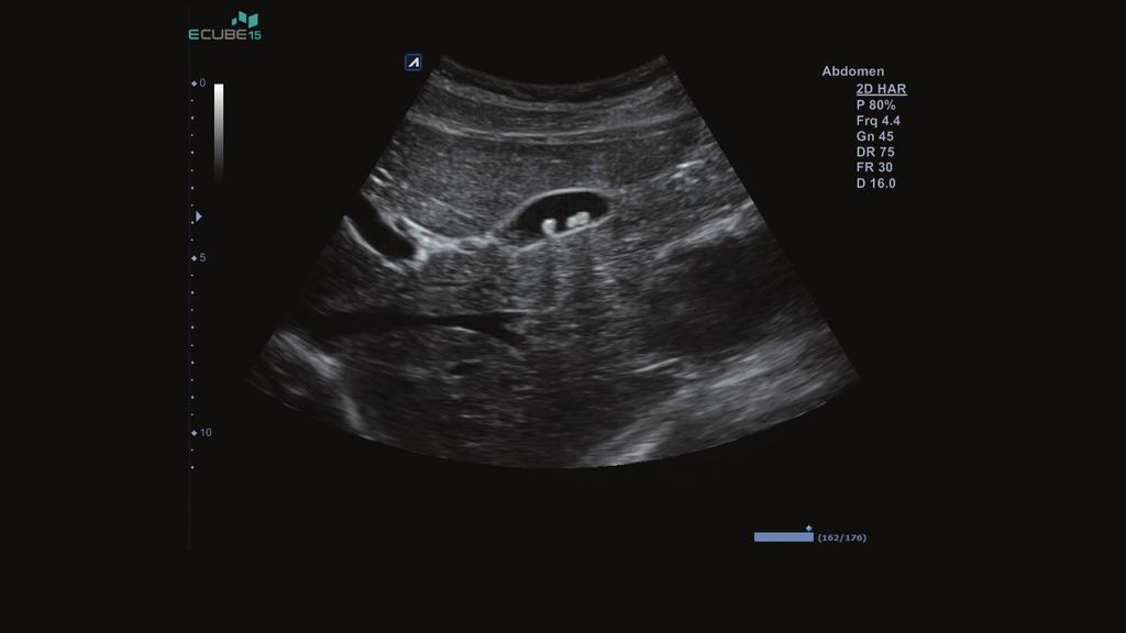 definition resolution Abdominal image in harmonics with Crystal Signature transducer (SC1-6H)