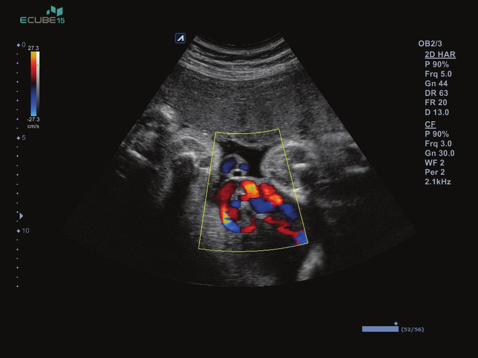 Breast image with ALPINION s extereme fine-pitched linear